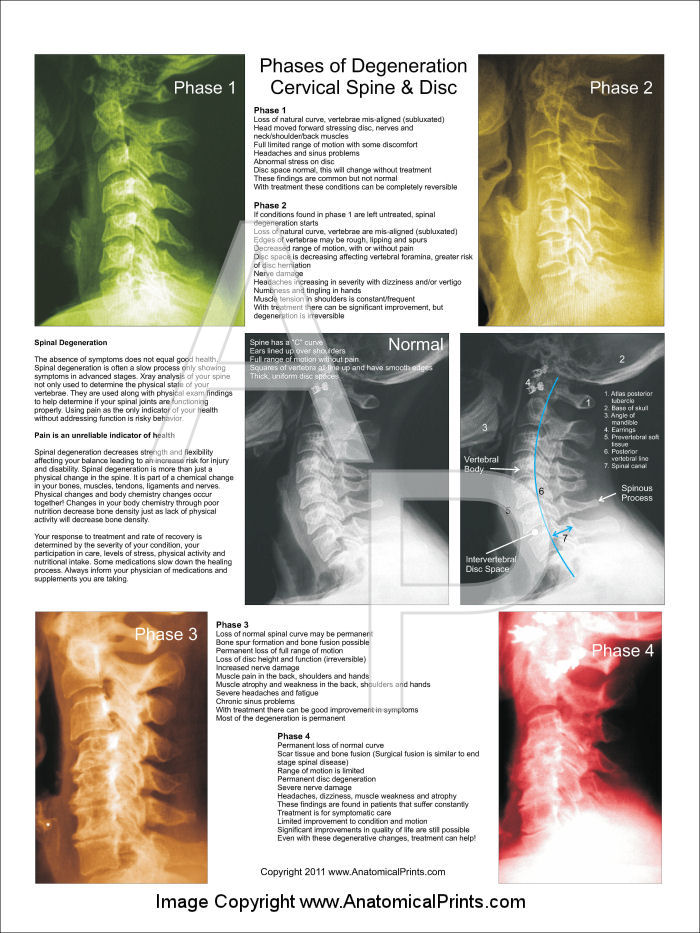 Cervical Spinal Degeneration Poster – 18 X 24