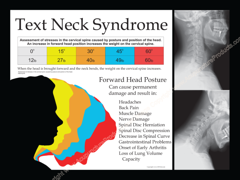 Text Neck Syndrome Poster – 18 X 24