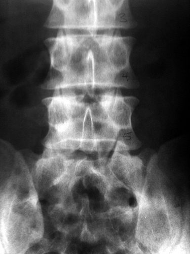 AP Lumbar Spine X-Ray