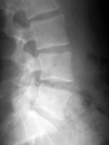 Lateral Lumber Spine X-Ray