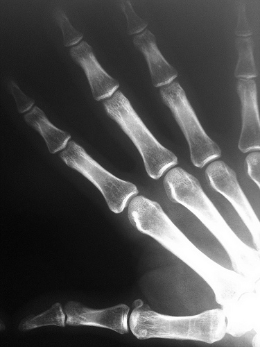 Right Hand X-ray