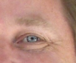 botulinum toxin and strabismus