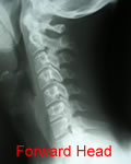 X-Ray Showing Straight Neck