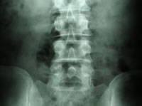 Lumbar Spine X-Ray AP