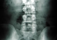 lumbar x-ray chiropractic