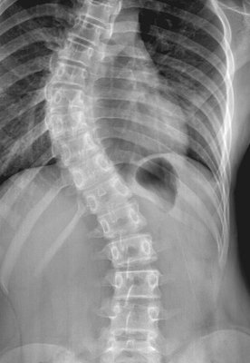 Scoliosis - Spinal Xray